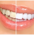 Teeth Whitening