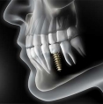 London Dental Implants to address your missing teeth