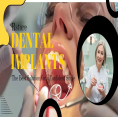 offer on teeth implants services