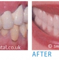 Best Teeth Whitening Treatment in Wimbledon